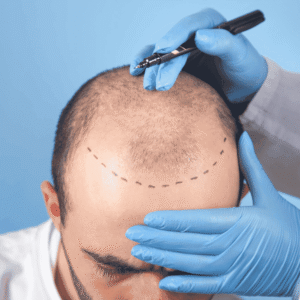 best hair transplantation in hyderabad