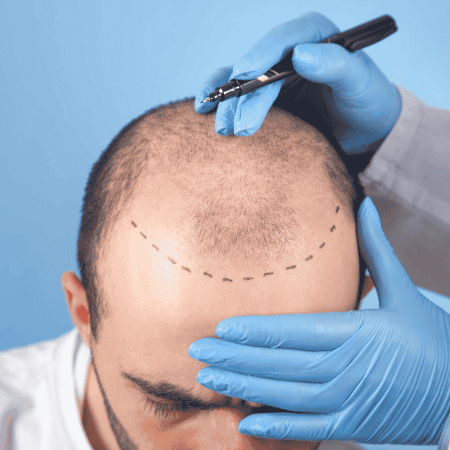 Best Hair Transplantation in Hyderabad